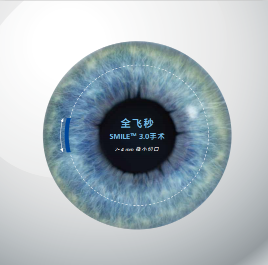 全飞秒激光近视手术可靠吗?足够安全吗？