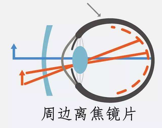 离焦镜片适用于哪些人群？