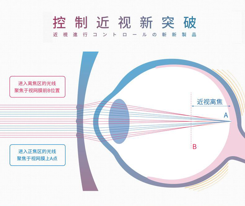 离焦镜片适合孩子戴吗?能控制近视吗?