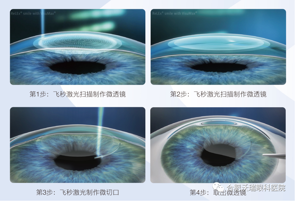 德国蔡司新一代全飞秒近视手术设备落户合肥沃瑞眼科医院！