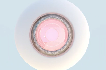 prl悬浮镜手术要多少钱？哪里能做？