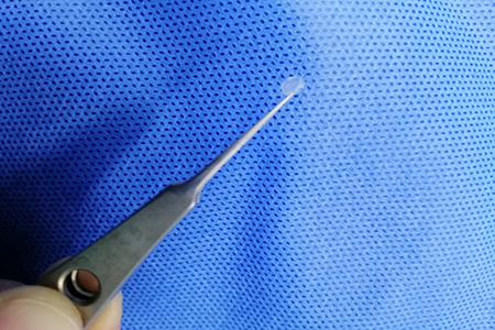 高度近视又不能做合肥激光手术怎么办？