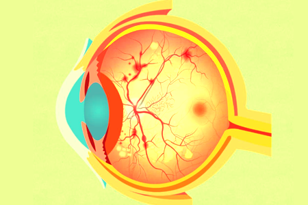 视网膜脱离和高度近视的那些事儿！