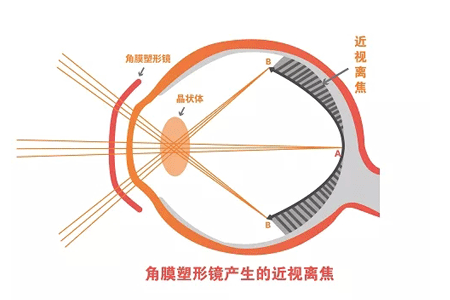 戴OK镜可以贴眼贴吗？这个请你牢记