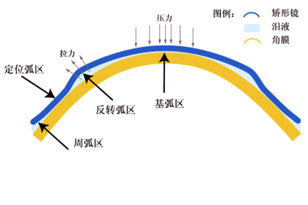 戴OK镜可以贴眼贴吗？这个请你牢记