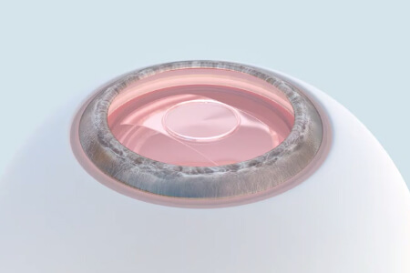 PRL悬浮镜手术需要多少钱？适合人群包括哪些？