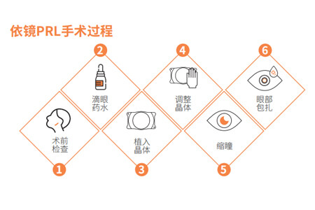 什么是依镜PRL？1分钟带你了解