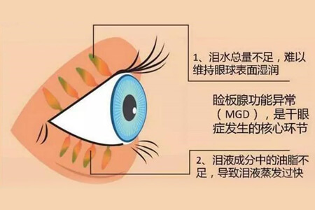 什么是干眼SPA？治疗流程有哪些？