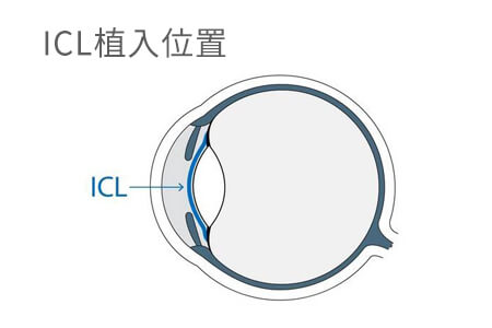 想做ICL手术，这4条你得知道