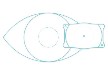 ICL人工晶体植入术有哪些缺点？