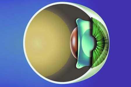 高度近视使用晶体植入术怎么样？