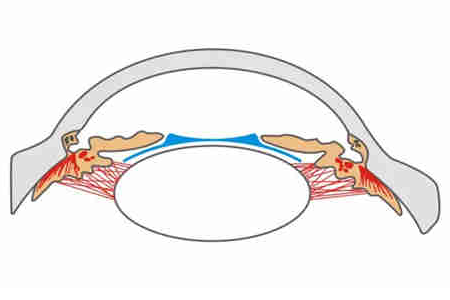 PRL晶体植入术有哪些危害性？