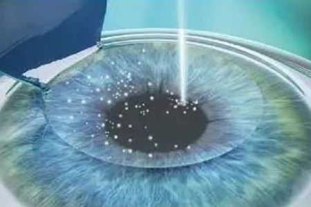 该怎样纠正近视眼呢？