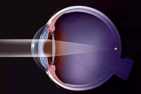 ICL晶体植入手术费用影响因素介绍