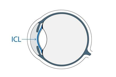 ICL人工晶体植入术和激光手术的优劣势分别是什么？
