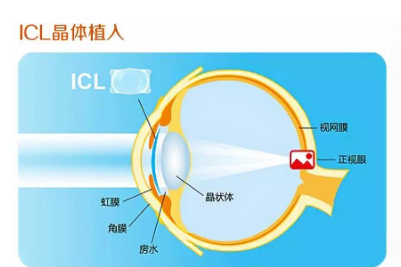 ICL人工晶体植入手术后遗症多不多？