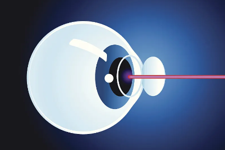 合肥精雕飞秒激光近视手术多少钱？