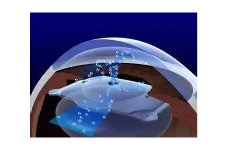 ICL晶体植入术适合高度近视吗？后遗症都有哪些？ 