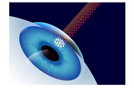 激光矫正近视眼手术的利弊分享？