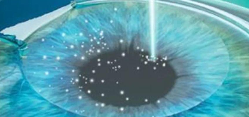 激光近视手术后多久可以正常用眼？