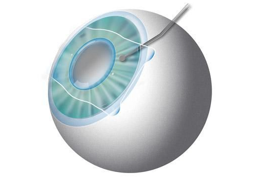 近视人工晶体手术后能喝酒吗？