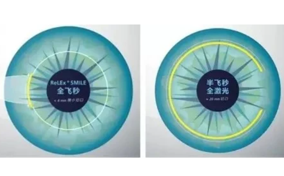 近视激光全飞秒和半飞秒的区别体现？