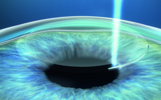 做完全飞秒第二天可以上班吗？