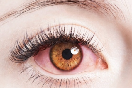 如何辨别是不是干眼症呢？