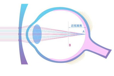 离焦镜眼镜是什么？有什么作用？
