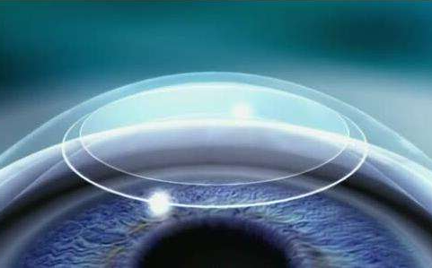 600度全飞秒切多少角膜？