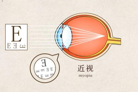 近视眼的非手术治疗方法？
