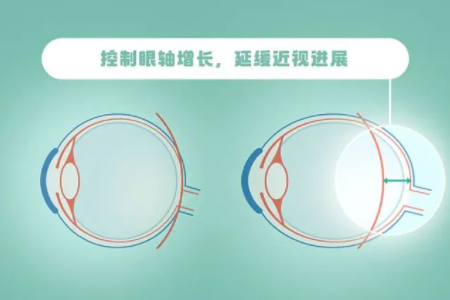 儿童智能近视眼镜能控制视力增长嘛？