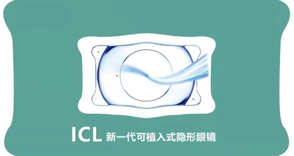 合肥ICL晶体植入近视手术，您了解多少？